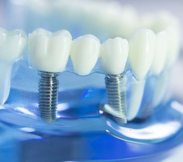 Prescott Dental Implants