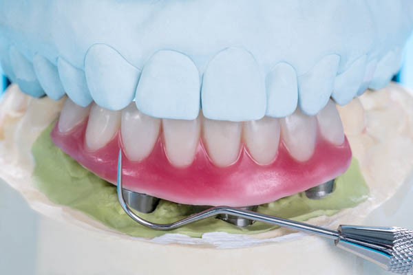 Implant Supported Dentures Prescott, AZ